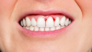 Gum Bleeding